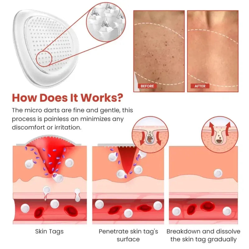 Skin Tag Remover Patch – Gentle & Painless Skin Care Solution 🎉 BUY 1 GET 1 FREE