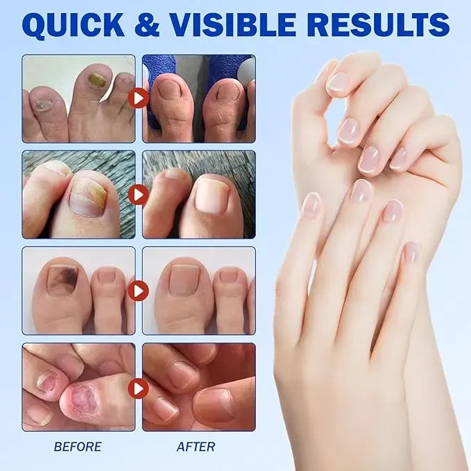 Nail Fungal Patches – Fast Nail Repair & Healthy Nail Care Patch 🔥 BUY 1 GET 1 FREE