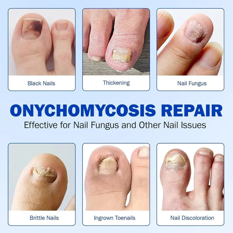 Nail Fungal Patches – Fast Nail Repair & Healthy Nail Care Patch 🔥 BUY 1 GET 1 FREE