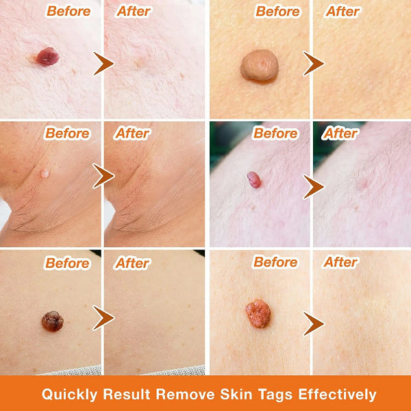 Premium Skin Tag Removal Patch – Soft on Skin, Tough on Tags 💎 BUY 1 GET 1 FREE