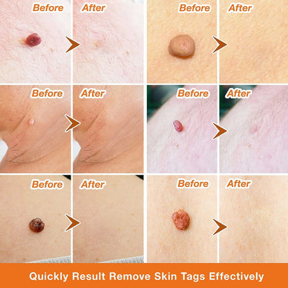 Premium Skin Tag Removal Patch – Soft on Skin, Tough on Tags 💎 BUY 1 GET 1 FREE