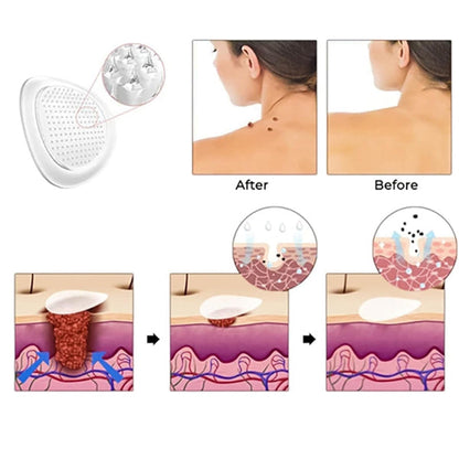 Premium Skin Tag Removal Patch – Soft on Skin, Tough on Tags 💎 BUY 1 GET 1 FREE