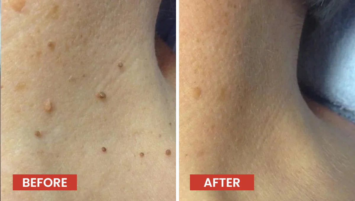 Skin Tag Remover Patch – Gentle & Painless Skin Care Solution 🎉 BUY 1 GET 1 FREE
